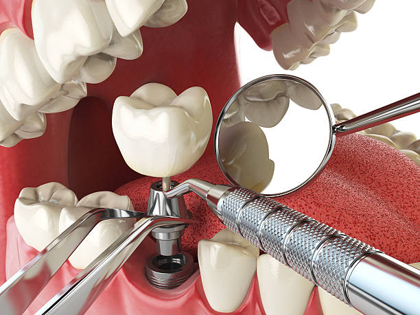 Best Broken or Chipped Tooth Repair in Sparta, WI